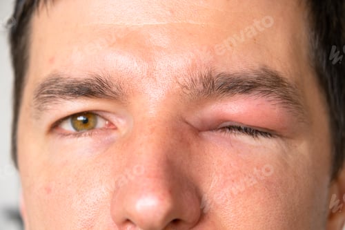 Preview: A red swollen eyelid on a man's face in close-up is an allergy to an insect bite. Allergic reaction