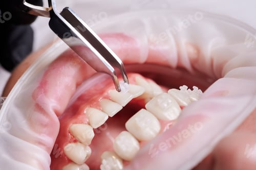 Preview: Process dental forceps attaching bracket to lower tooth.