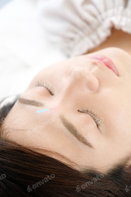 Preview: Up of a woman getting acupuncture on her face at an acupuncture clinic
