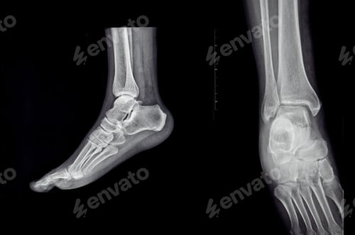 Preview: an x-ray of the sole of the human foot