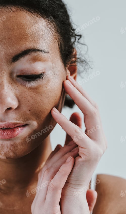 Preview: Beautiful woman with vitiligo skin