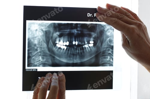 Preview: X-ray image of teeth