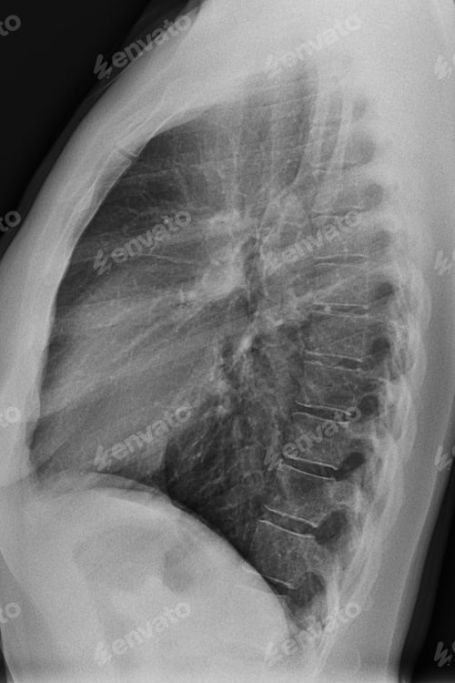 Preview: Real Chest X-Ray Scam Showing Ribcage and Lung Structure in lateral view