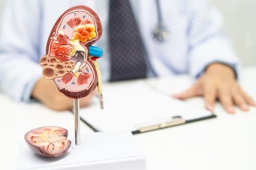 Preview: Chronic kidney disease ckd, Doctor hold human model to treat