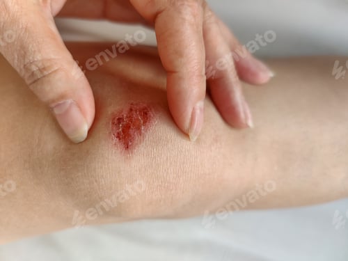 Preview: Wound on knee of slender young woman. Healing of skin lesion after fall.