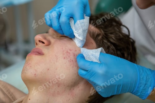 Preview: Acne treatment in a teenager.