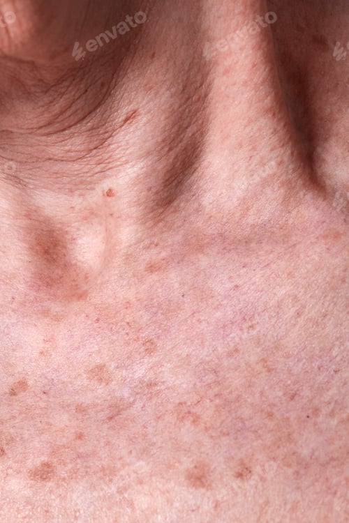 Preview: Aging female skin with melasma spots
