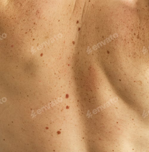 Preview: Skin on a man back with scattered moles