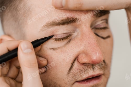 Preview: Male eye correction markings before blepharoplasty operation