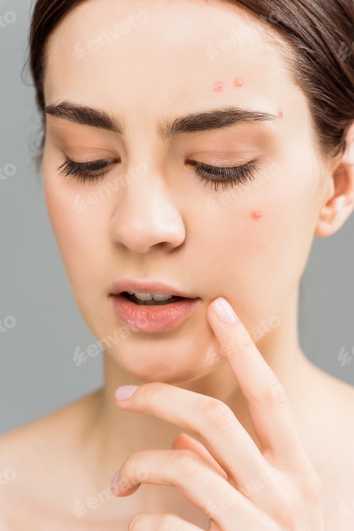 Preview: close up of attractive young brunette woman with acne touching face isolated on grey