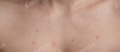 Preview: A close-up of a panoramic shot of a woman's skin prone to acne and other dermatological problems.