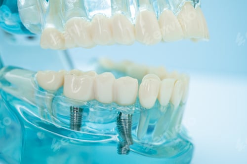 Preview: Dental implant, artificial tooth roots into jaw, root canal of dental treatment, gum disease,
