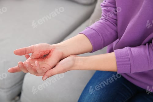 Preview: Young woman with injured hand at home, closeup. First aid