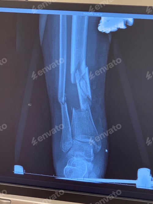 Preview: Compound fracture