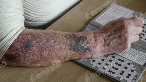 Preview: High angle shot of an elderly person's hand covered with rash and scars