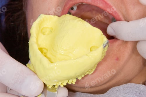 Preview: oral rehabilitation process, partial removable prosthesis
