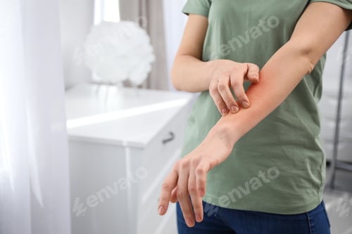 Preview: Woman with allergy symptoms scratching forearm indoors, closeup. Space for text