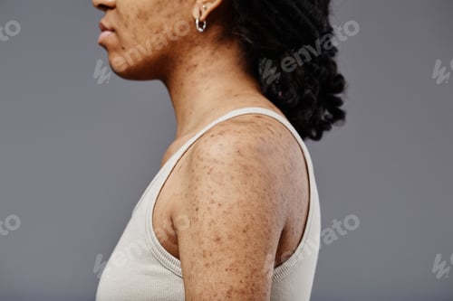 Preview: Woman with acne scars