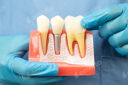 Preview: Asian dentist holding dental implant, artificial tooth roots into jaw, root canal of dental