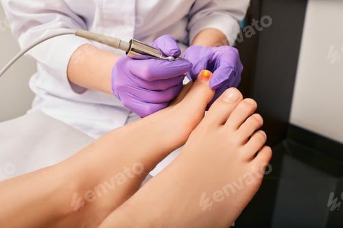 Preview: Treatment fungal infection on woman's toenail with podologist using a medical laser. Fungal