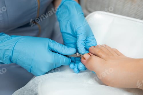 Preview: Podologist during the procedure of ingrown nail removal with clippers