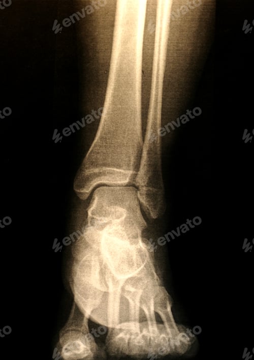 Preview: X-ray of a foot