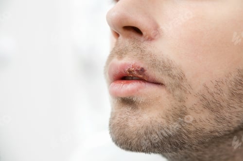 Preview: Young man suffering from herpes on his mouth