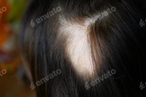 Preview: Woman hair loss. Head of woman on part of skin of which there is no hair.