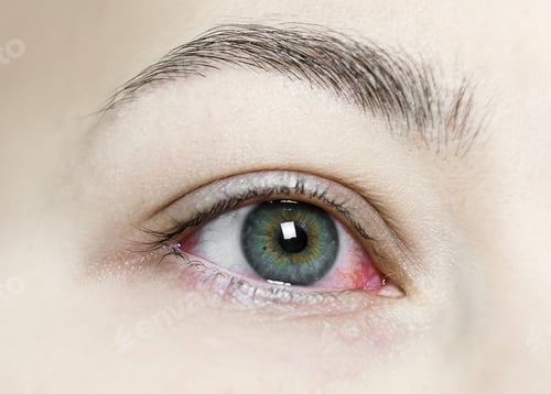 Preview: Close up of a severe bloodshot red eye. Viral Blepharitis, Conjunctivitis, Adenoviruses. Irritated