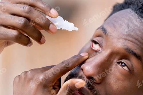 Preview: Close up of a black skinned man with dry eyes applying artificial tears in spring in a park
