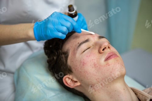 Preview: Treatment of acne in adolescents. Facial peeling to fight acne on the face