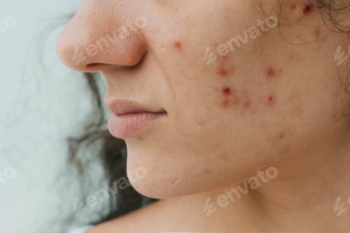 Preview: Close-up of a young woman with acne on her face and skin problems.