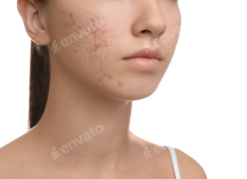 Preview: Teenage girl with acne problem on white background, closeup