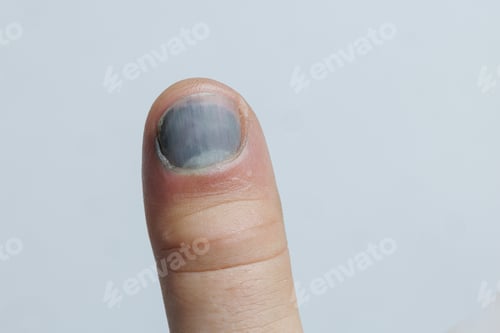Preview: Subungual hematoma on thumb close up nail injury medical concept