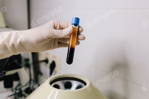 Preview: PRP preparation involves centrifuging blood to isolate plasma rich in platelets