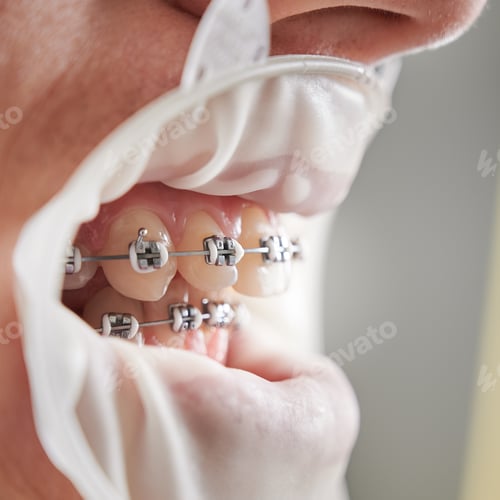 Preview: Teeth with metal braces and cofferdam in mouth.