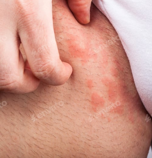 Preview: Eczema groin