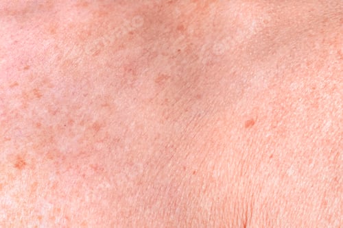 Preview: Aging female skin with melasma spots