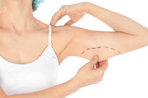 Preview: Woman with marks on arm for cosmetic surgery operation against white background, closeup