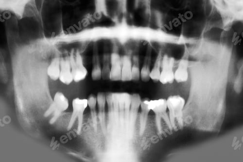 Preview: Dental X-Ray
