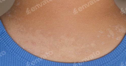 Preview: Sunburned man, sunburned heavily on shoulder