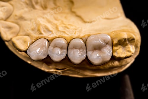 Preview: Dental prosthesis