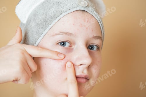 Preview: Problematic skin. Acne and red festering pimples on the face of a young girl.