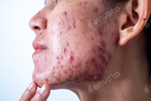 Preview: Acne on face because the disorders of sebaceous glands productions. Acne or a Cosmetic Allergy.