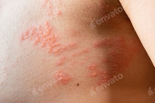 Preview: chickenpox rash. Shingles, varicella-zoster virus. skin rash and blisters on body