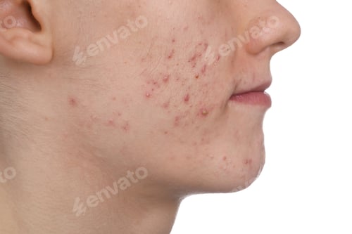 Preview: Young man with acne problem isolated on white, closeup