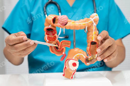 Preview: Colorectal cancer, doctor holding intestine colon human model.