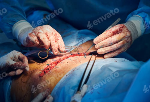 Preview: Doctor placing sutures after abdominoplasty surgery.