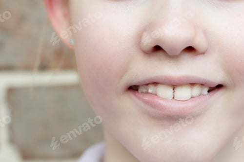 Preview: Teenage girl wearing Invisalign invisible braces to straighten teeth. Orthodontic treatment