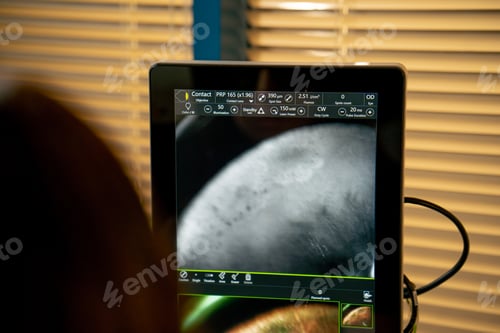 Preview: close-up diagnostic screen with image of the eye indicator of moisture and dry areas check doctor